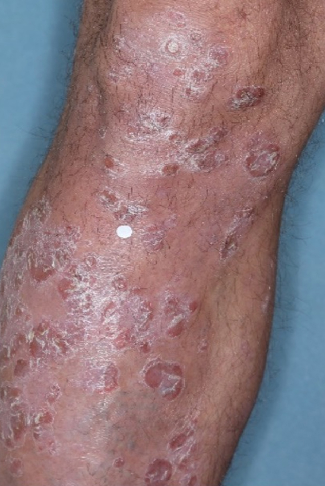 Before and after photos of patient who treated their leg  with VTAMA cream