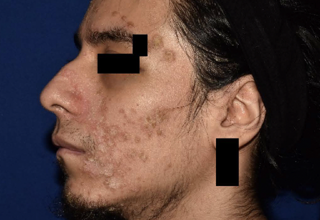 Before & after photos of a male adult patient treated on the face with VTAMA cream