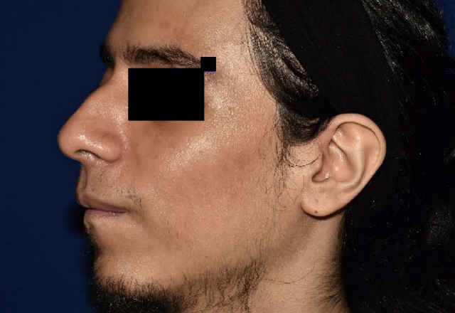 Before & after photos of a male adult patient treated on the face with VTAMA cream
