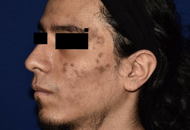 Before & after photos of a male adult patient treated on the face with VTAMA cream