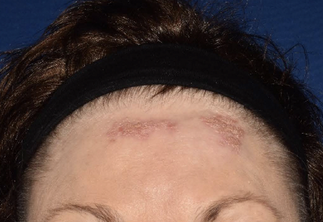 Before & after photos of a female adult patient treated on the forehead with VTAMA cream