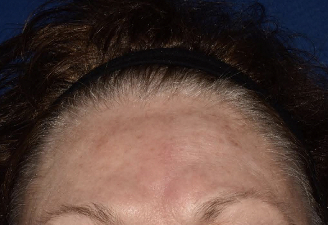 Before & after photos of a female adult patient treated on the forehead with VTAMA cream