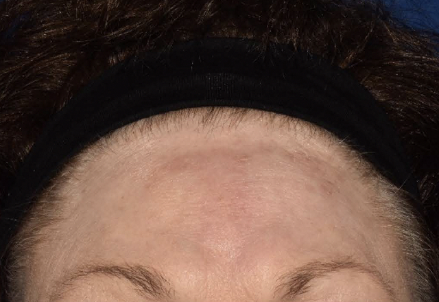 Before & after photos of a female adult patient treated on the forehead with VTAMA cream