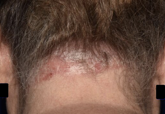 Before & after photos of a female adult patient treated on the scalp with VTAMA cream