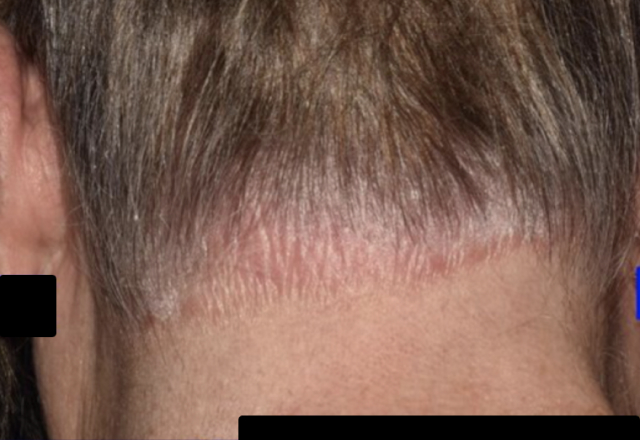 Before & after photos of a female adult patient treated on the scalp with VTAMA cream