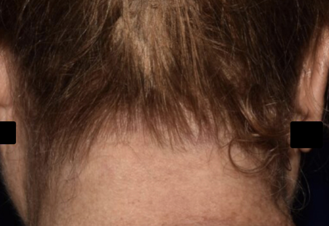 Before & after photos of a female adult patient treated on the scalp with VTAMA cream