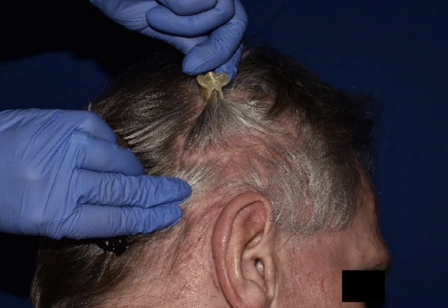 Before & after photos of a male adult patient treated on the scalp with VTAMA cream