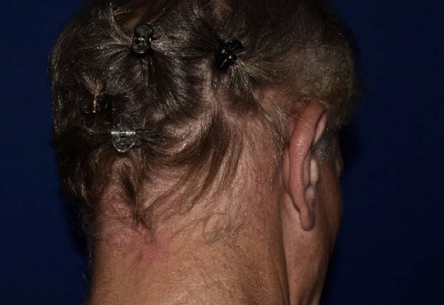 Before & after photos of a male adult patient treated on the scalp with VTAMA cream