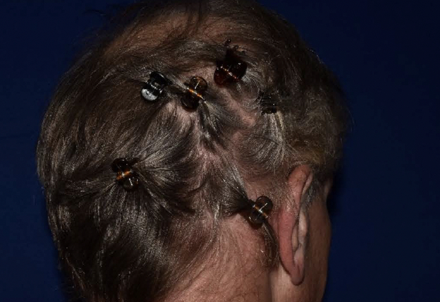 Before & after photos of a male adult patient treated on the scalp with VTAMA cream