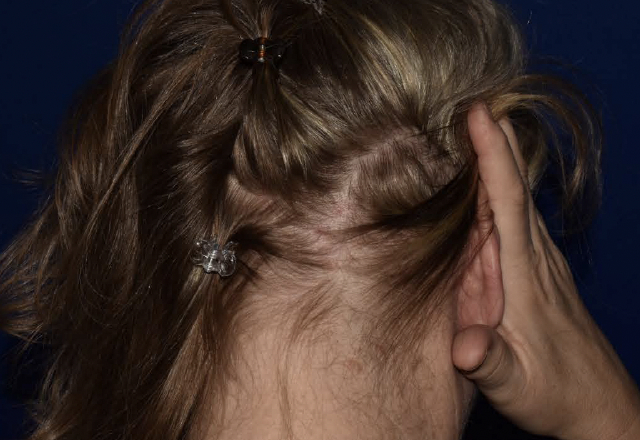 Before & after photos of a female adult patient treated on the lower scalp with VTAMA cream