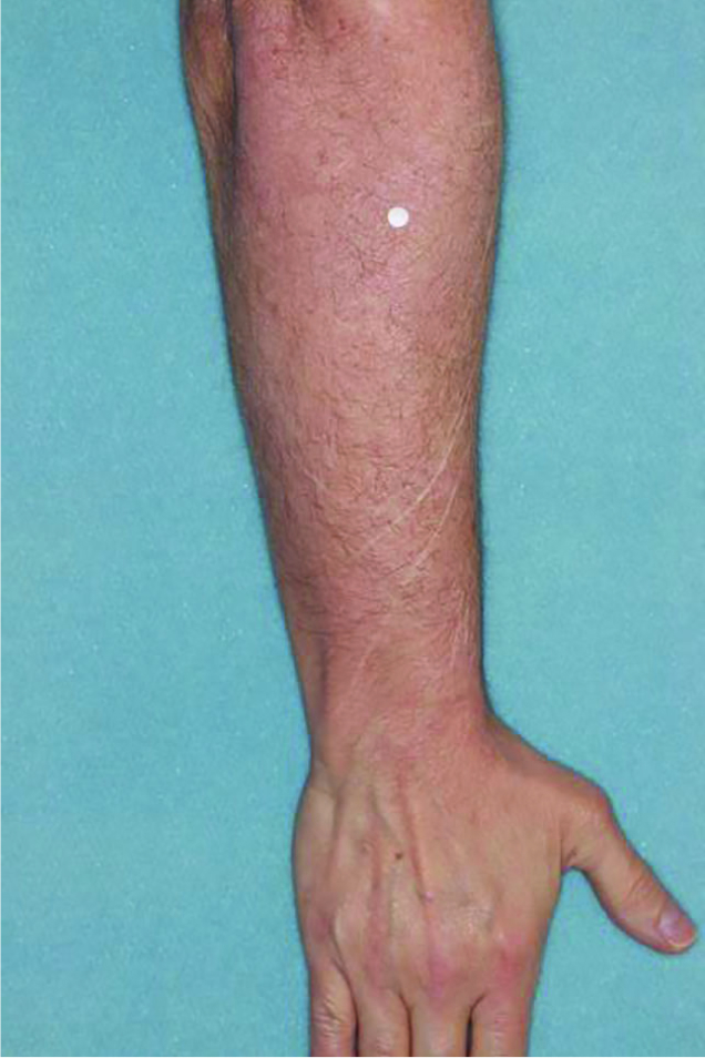 Before and after photos of patient who treated their arm with VTAMA cream