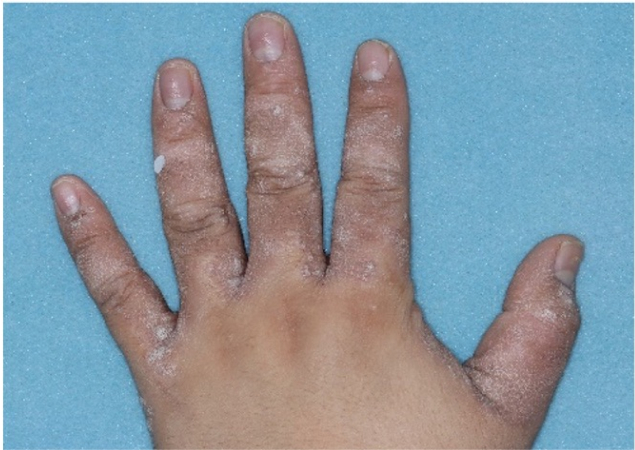 Before and after photos of patient who treated their hand with VTAMA cream