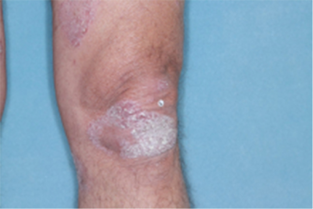 Before and after photos of patient who treated their knee with VTAMA cream