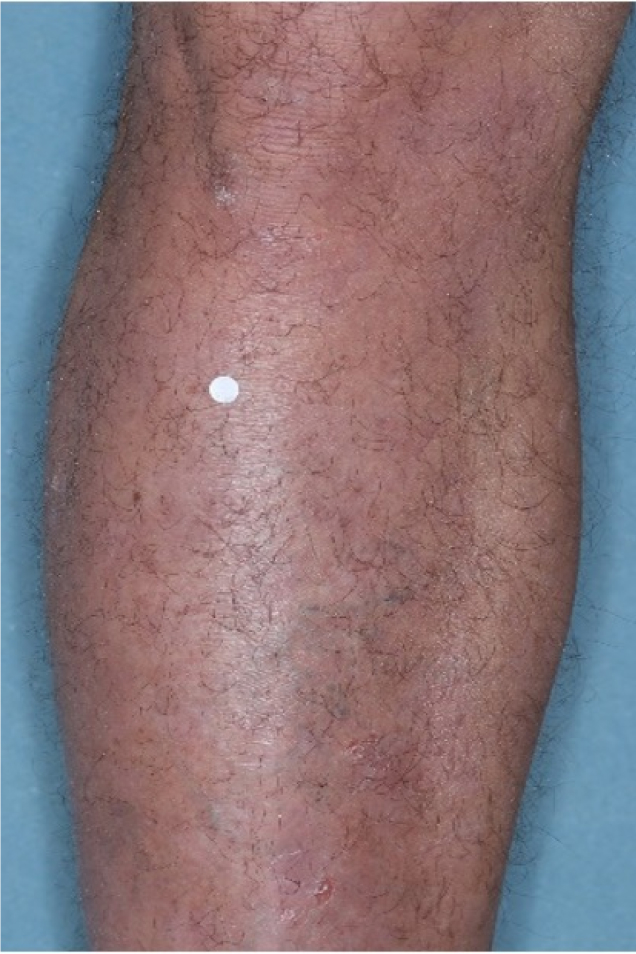 Before and after photos of patient who treated their leg  with VTAMA cream